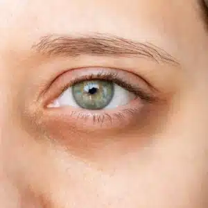 Gros plan sur le contour des yeux présentant des cernes bleutés.